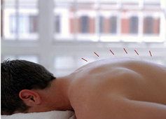 ACUPUNTURA