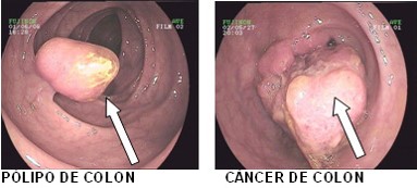 Hidroterapia de colon