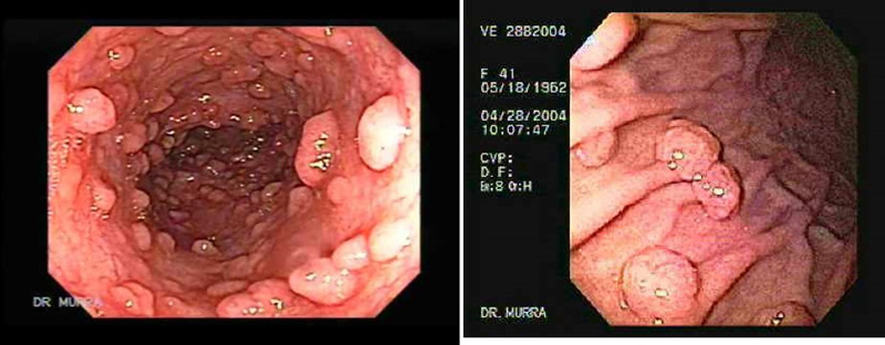 Hidroterapia de colon